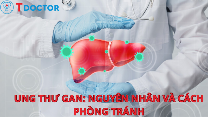 Ung thư gan là một căn bệnh nguy hiểm và đang ngày càng gia tăng trên toàn thế giới. Theo thống kê của Tổ chức Y tế Thế giới (WHO), ung thư gan đứng thứ 2 về số ca mắc và đứng đầu về số ca tử vong. Vậy nguyên nhân gây ra căn bệnh này là gì? Có những triệu chứng gì để nhận biết và làm thế nào để điều trị và phòng tránh ung thư gan? Chúng ta hãy cùng Tdoctor và GENK tìm hiểu chi tiết trong bài viết này.